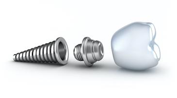 dental implant in 3 parts | dental implants beaverton