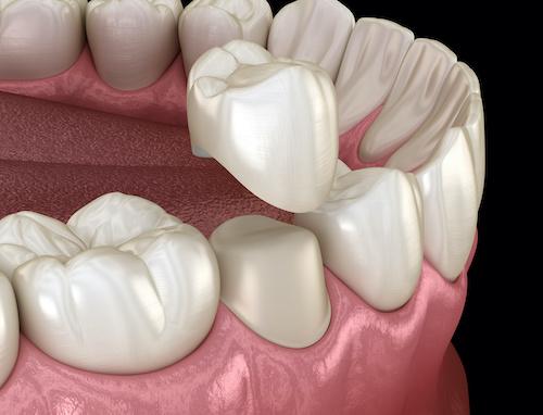 dental crown image | Beaverton or dentist