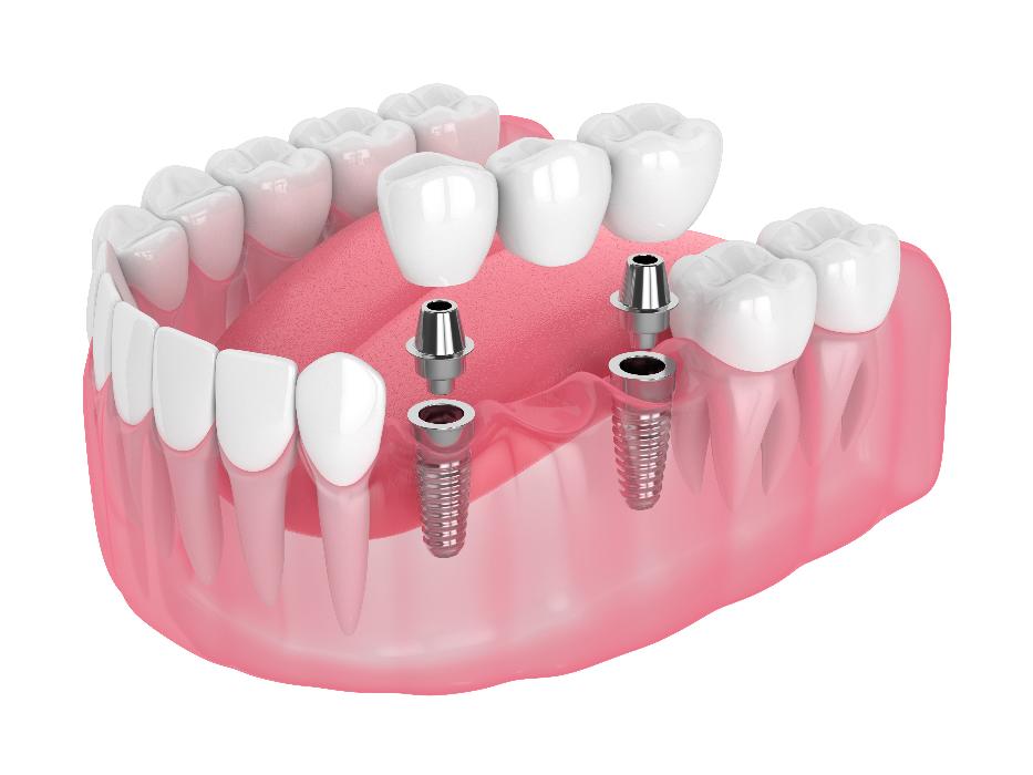dental implants going in jaw | dental implants beaverton or
