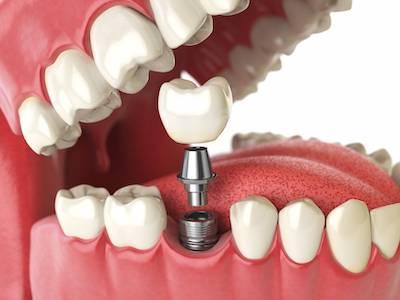 close up of implant going in jaw | dental implants beaverton