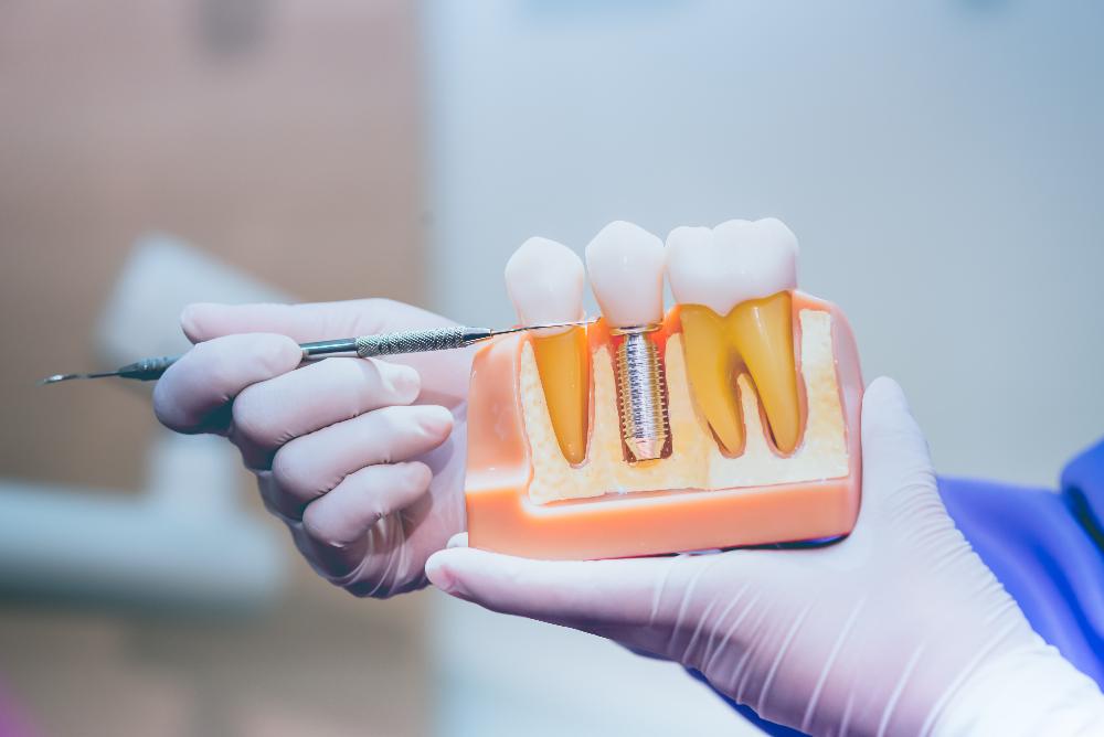 close up of 3D model of dental implant | dental implants beaverton or