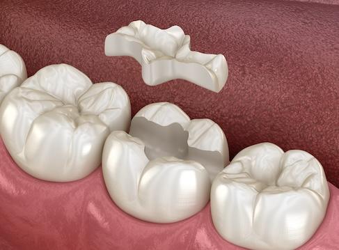 inlays going on a tooth in beaverton