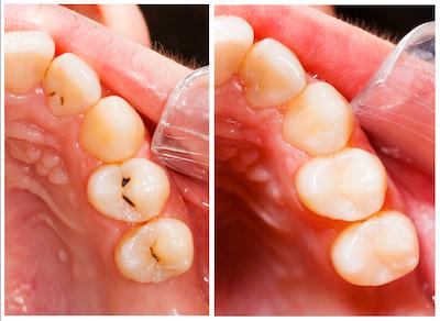 Cavities Before & After | Beaverton Dentist