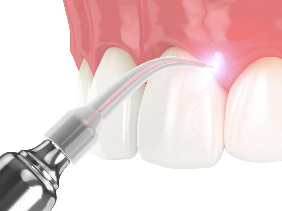 laser tool on gum | laser dentistry beaverton