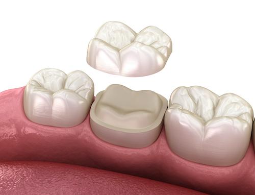 onlays being placed on a tooth 