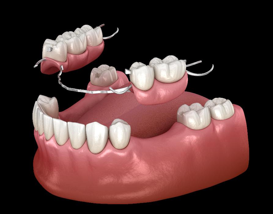 partial dentures | dentures beaverton or