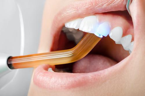 Person getting filling for cavity | Beaverton Dentist