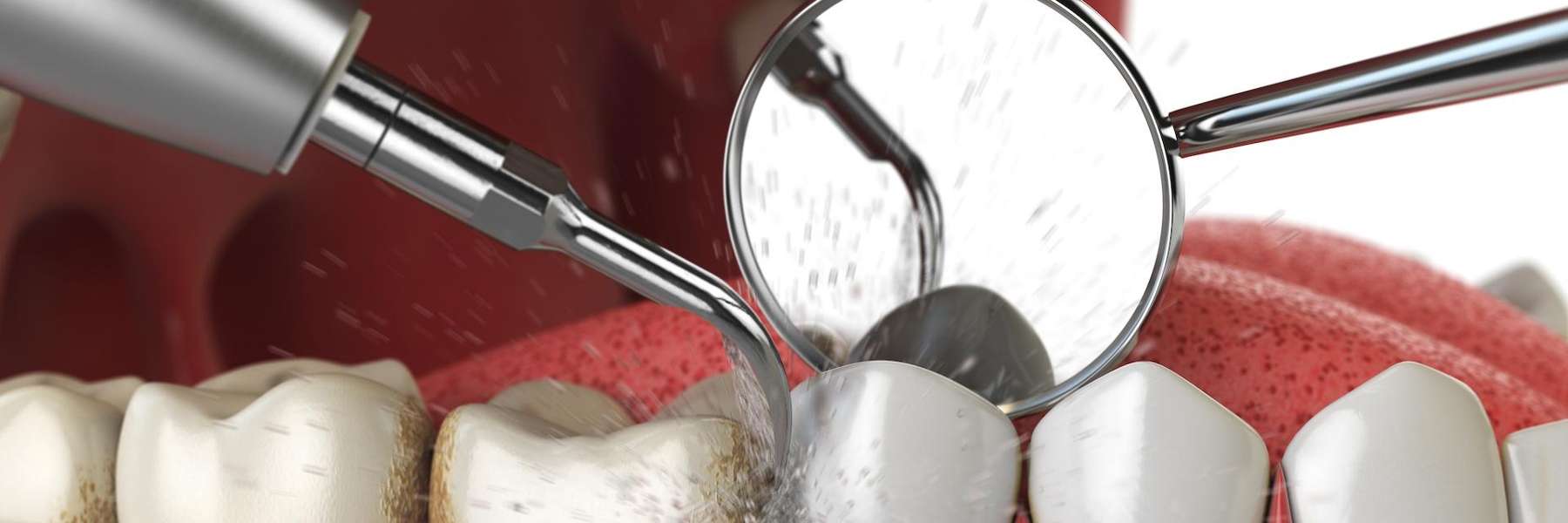 Picture showing tooth extraction process | beaverton dentist 