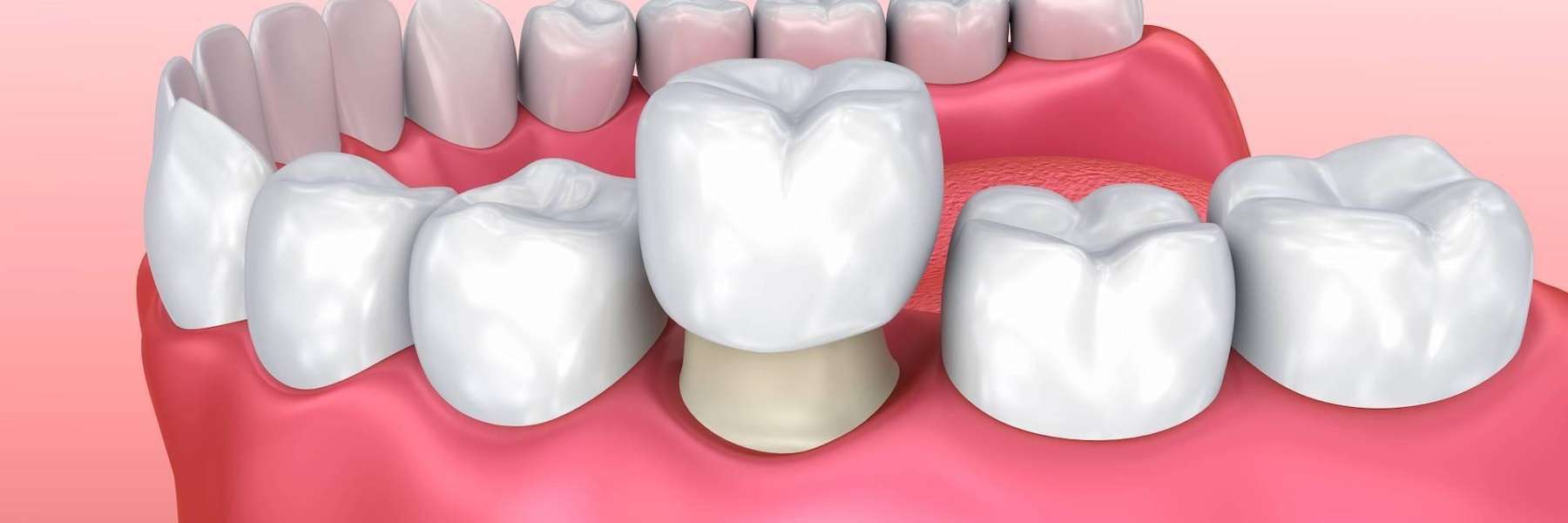 A model of Dental Crown in in Beaverton