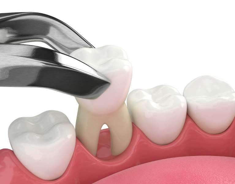 tool extracting tooth in jaw | tooth extraction beaverton or