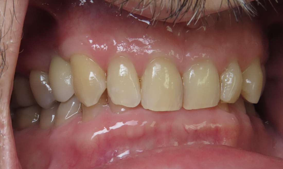 functional smile after dental treatment | dentist beaverton or