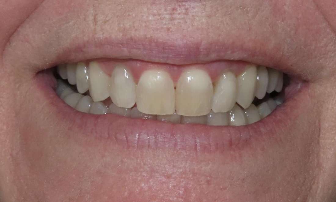 Patient's teeth after using aligners from Neish Dentistry | invisalign braces beaverton