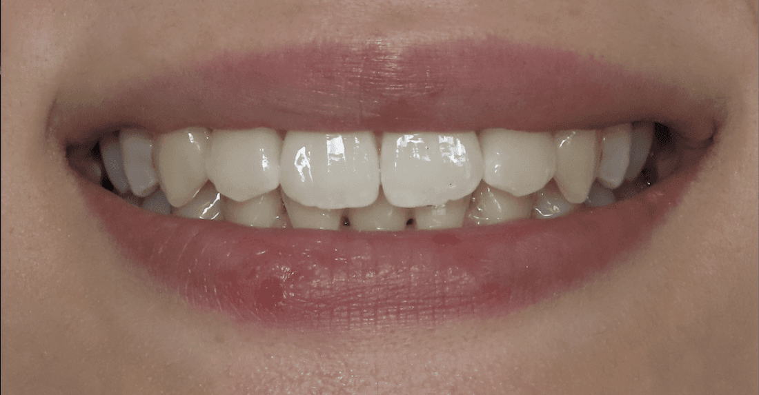 Patient's teeth after getting dental implant from Neish Dentistry | dental implants beaverton or