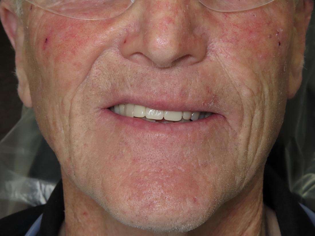 Patient's complete smile after getting dentures | dentures beaverton or