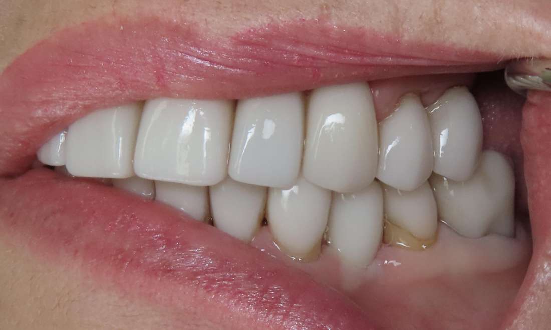 complete smile after dental treatment | dental implants beaverton or