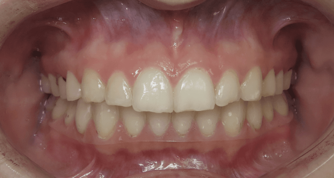 Patient's teeth before getting Composite Tooth Fillings | dental fillings beaverton