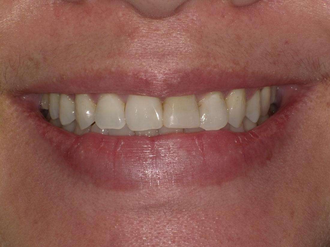 Patient's teeth before getting dental crowns | dental crowns beaverton or