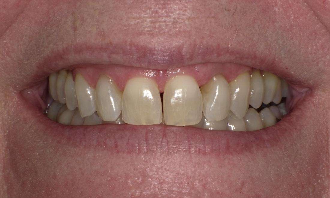 Patient's teeth before using aligners | clear aligners beaverton