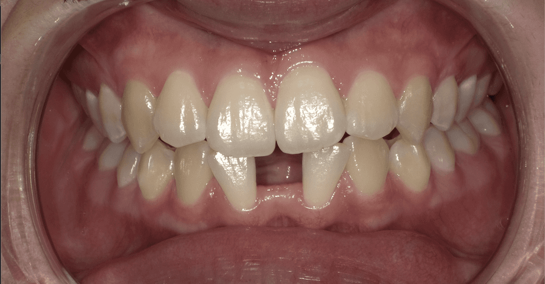 Patient's teeth before getting dental implant from Neish Dentistry | clear aligners beaverton