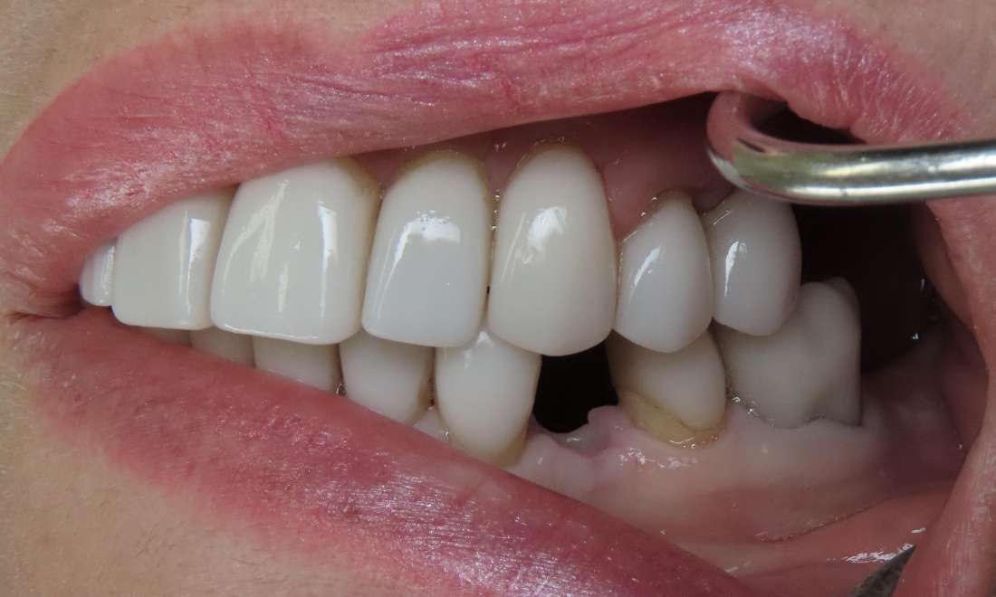 missing tooth before dental implants | beaverton dentist