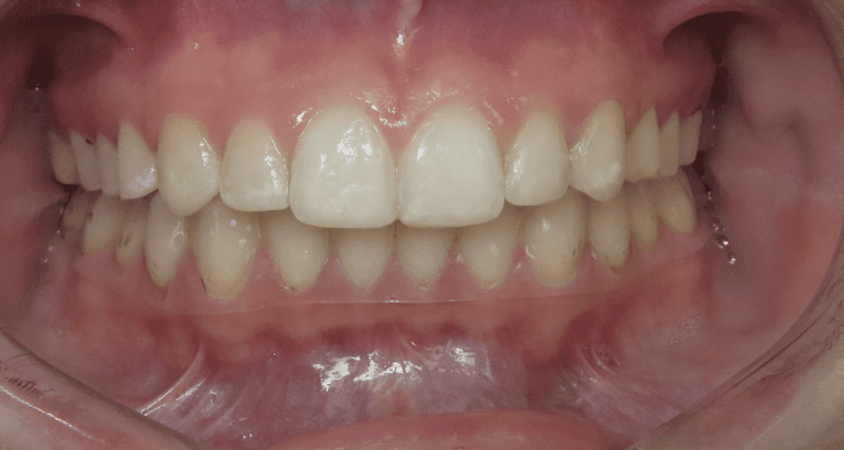 Composite-Tooth-Fillings-Before-After-After-Image