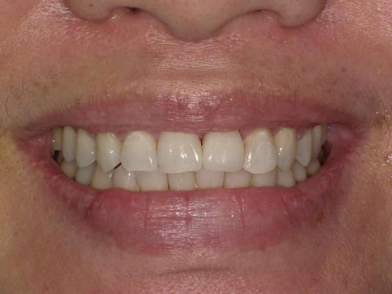 CEREC-Crowns-Before-After-After-Image