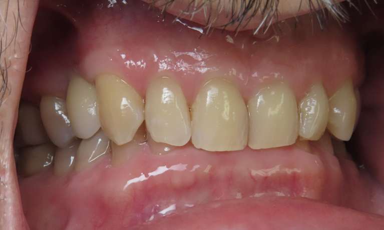 functional smile after dental treatment | dentist beaverton or