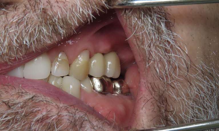 New-teeth-with-dental-implants-After-Image
