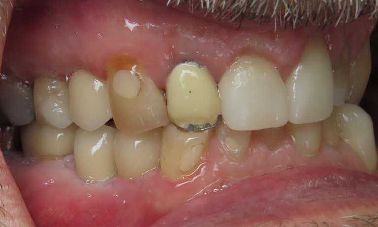 complete smile after dental implants | beaverton dentist