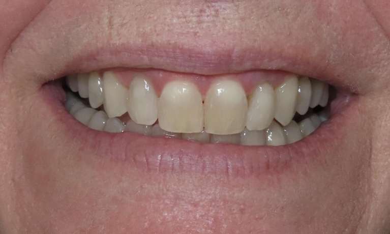 Clear-Correct-Before-After-After-Image