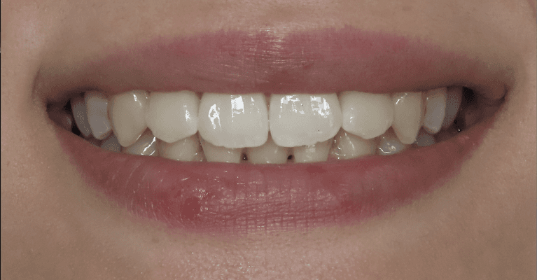 Complete-Smile-With-Clear-Correct-Dental-Implants-After-Image