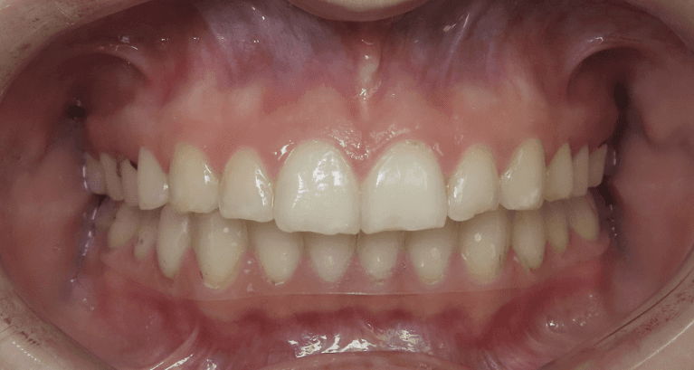 Composite-Tooth-Fillings-Before-After-Before-Image