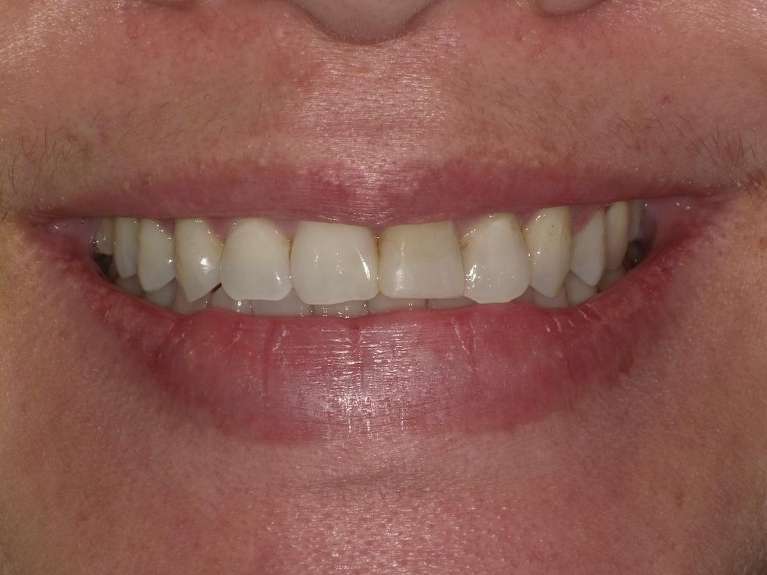 CEREC-Crowns-Before-After-Before-Image