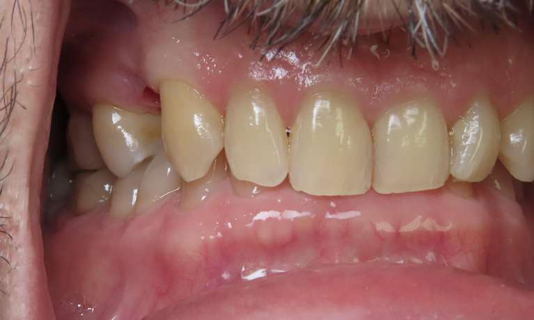 smile before dental implants | dental implants beaverton