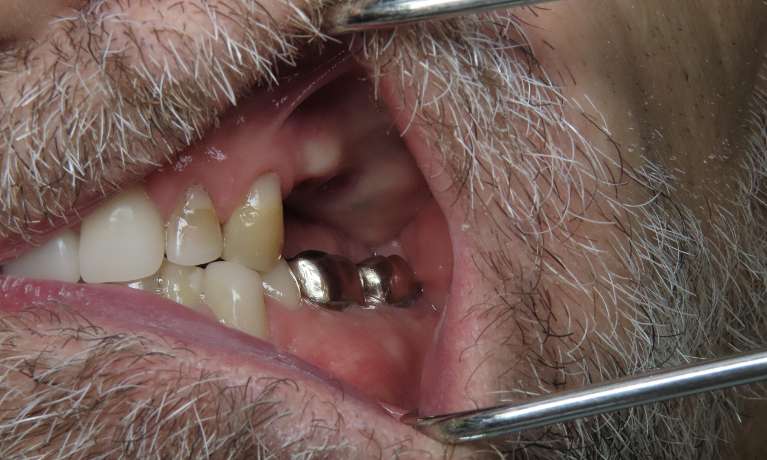 New-teeth-with-dental-implants-Before-Image