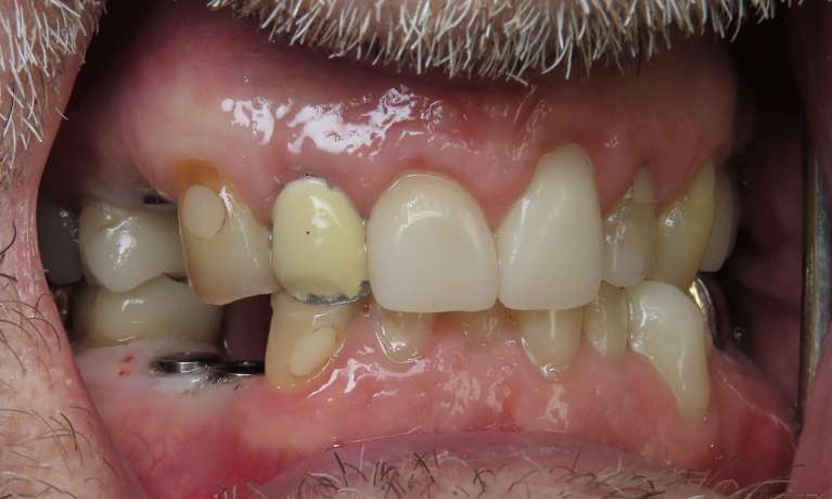 missing tooth in lower jaw | dental implants beaverton or