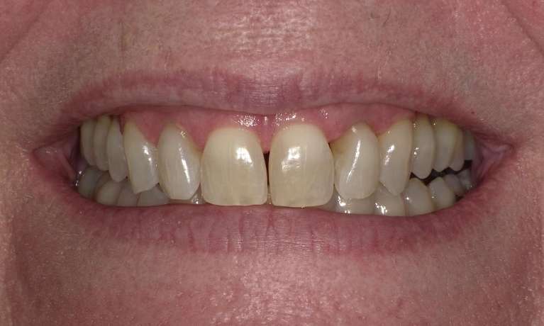 Clear-Correct-Before-After-Before-Image