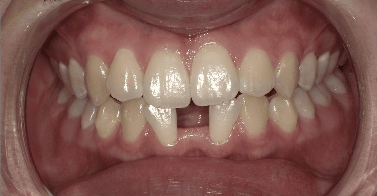Complete-Smile-With-Clear-Correct-Dental-Implants-Before-Image