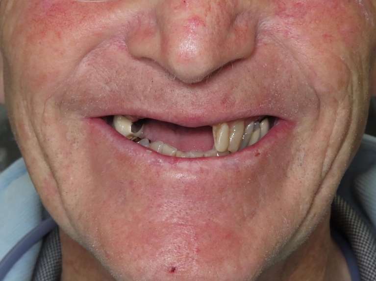 Partial-Dentures-Before-After-Before-Image