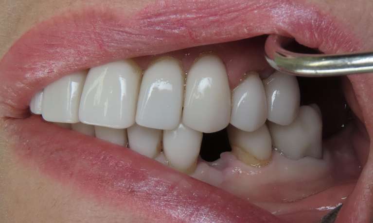 Replace-Missing-Teeth-with-Beaverton-Dental-Implants-Before-Image