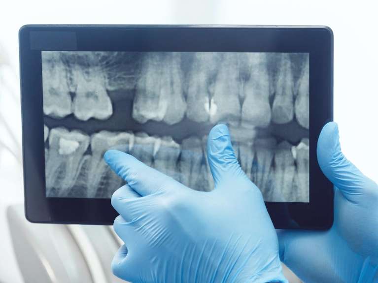 Digital X-Rays at Beaverton Dental Office